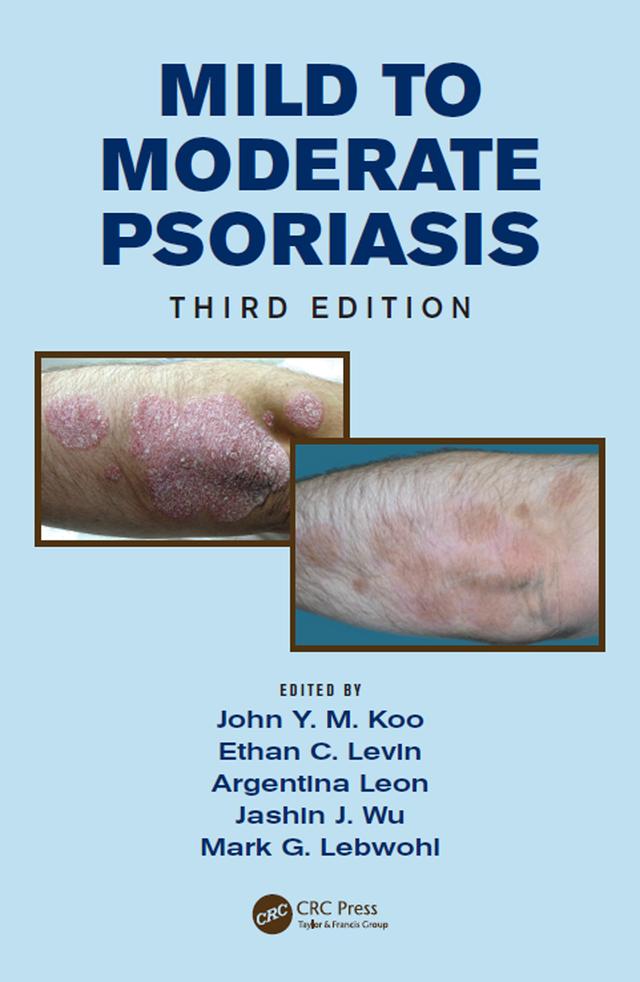 Mild to Moderate Psoriasis by Argentina Leon, Ethan Levin, Jashin Wu, John Koo, Mark Lebwohl