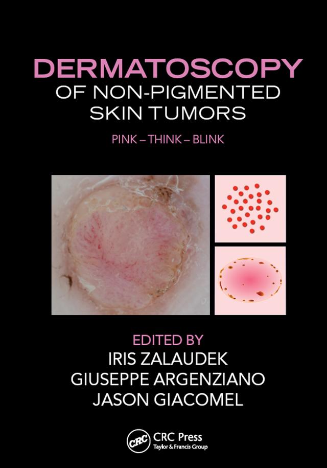 Dermatoscopy of Non-Pigmented Skin Tumors by Giuseppe Argenziano, Iris Zalaudek, Jason Giacomel