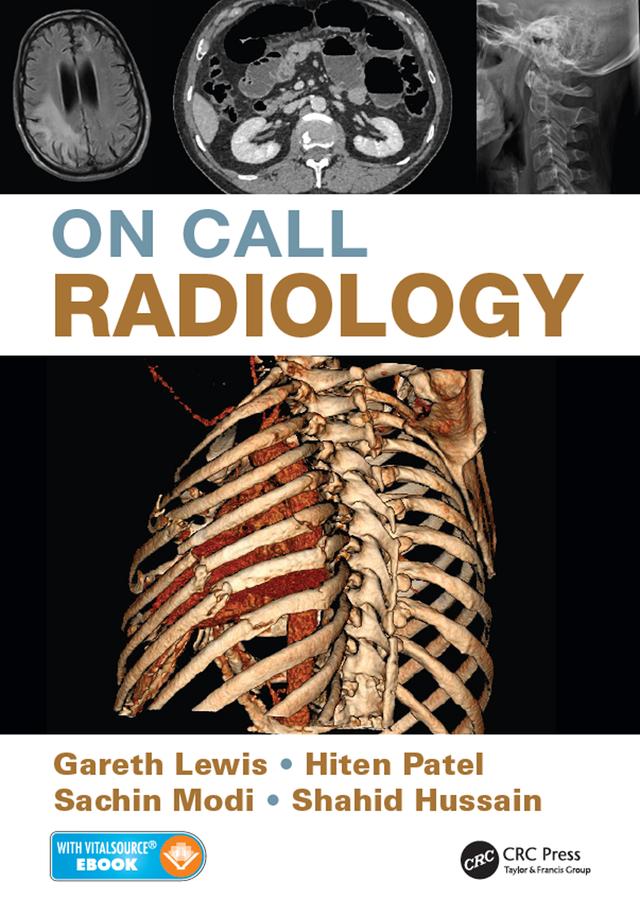On Call Radiology by Gareth Lewis, Hiten Patel, Sachin Modi, Shahid Hussain