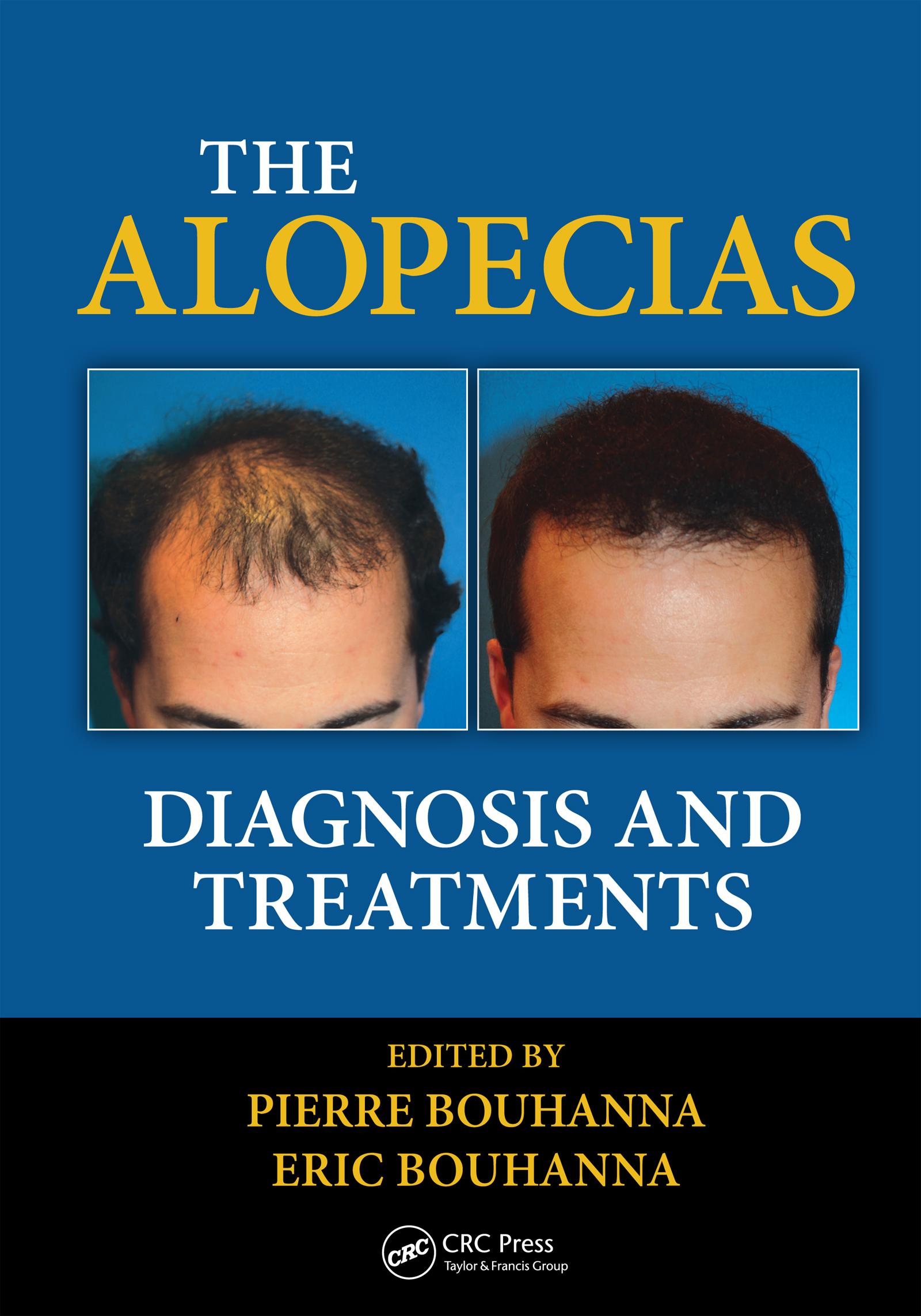 The Alopecias