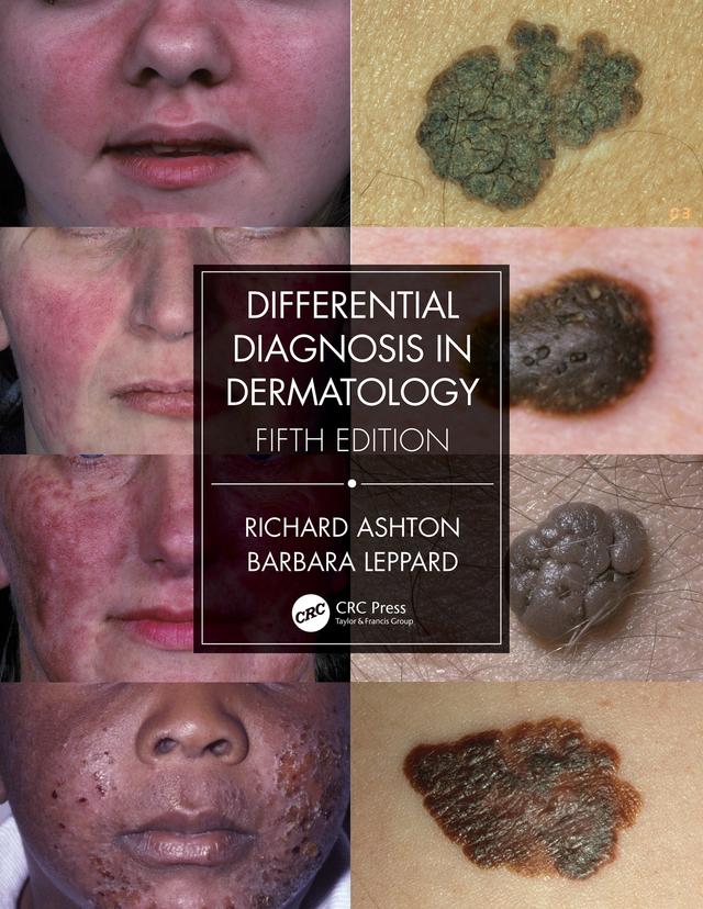 Differential Diagnosis in Dermatology by Barbara Leppard, Richard Ashton