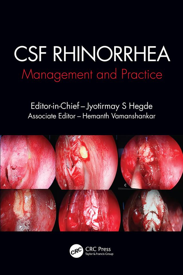 CSF Rhinorrhoea by Hemanth Vamanshankar, Jyotirmay S. Hegde