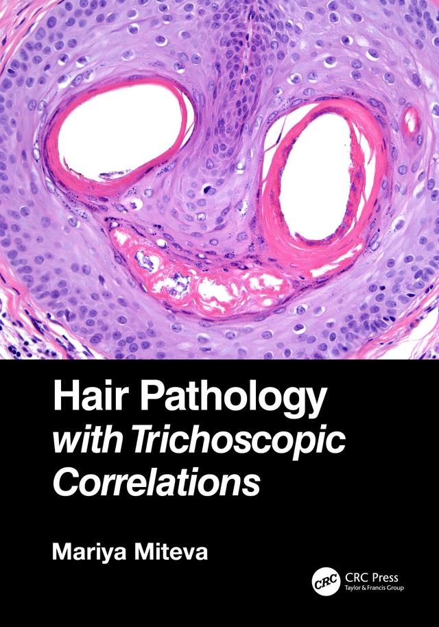 Hair Pathology with Trichoscopic Correlations by Mariya Miteva