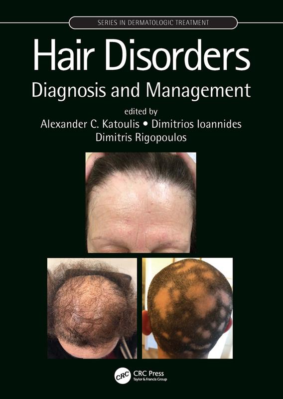 Hair Disorders by Alexander C. Katoulis, Dimitrios Ioannides, Dimitris Rigopoulos
