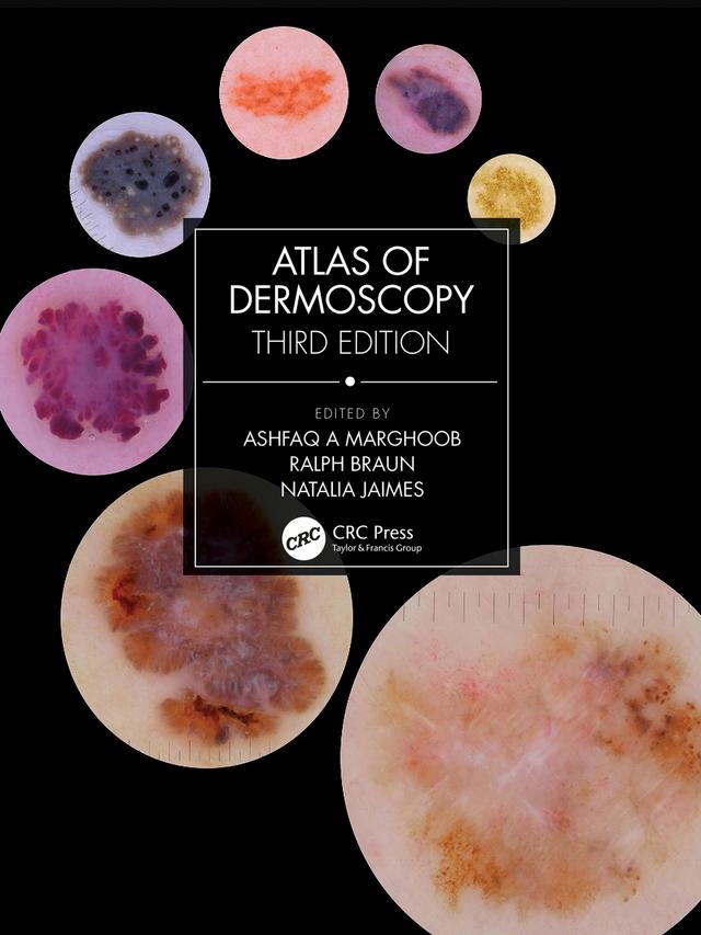 Atlas of Dermoscopy by Ashfaq A Marghoob, Natalia Jaimes, Ralph Braun