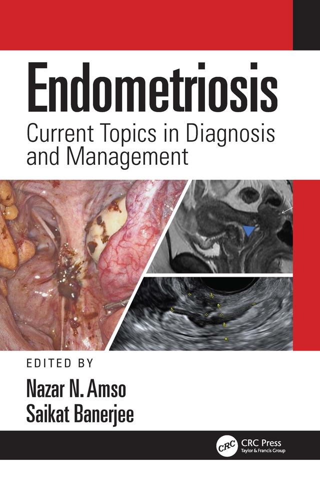 Endometriosis by Nazar Amso, Saikat Banerjee