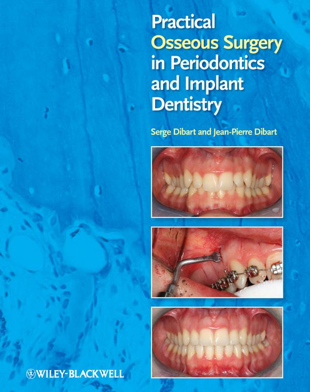 Practical Osseous Surgery in Periodontics and Implant Dentistry by Jean-Pierre Dibart, Serge Dibart