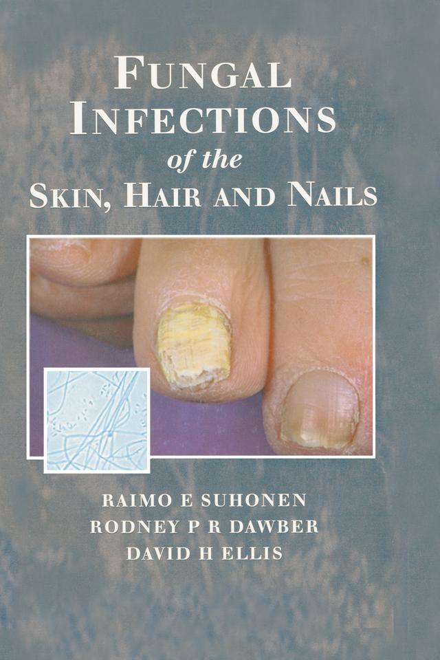 Fungal Infections of the Skin and Nails by David H. Ellis, Raimo E. Suhonen, Rodney P.R. Dawber