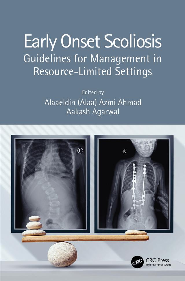 Early Onset Scoliosis by Aakash Agarwal, Alaaeldin (Alaa) Azmi Ahmad