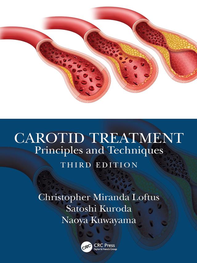 Carotid Treatment: Principles and Techniques by Christopher Miranda Loftus, Naoya Kuwayama, Satoshi Kuroda