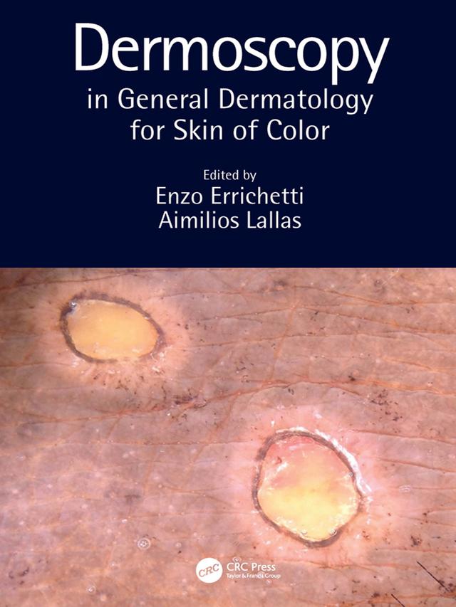 Dermoscopy in General Dermatology for Skin of Color by Aimilios Lallas, Enzo Errichetti