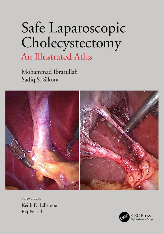 Safe Laparoscopic Cholecystectomy by Mohammad Ibrarullah, Sadiq S Sikora