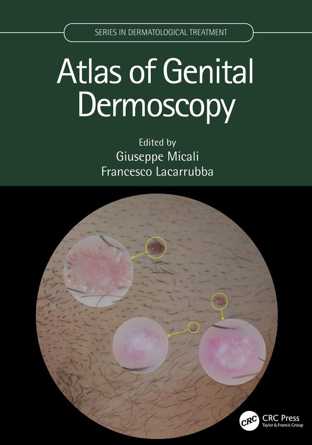 Atlas of Genital Dermoscopy by Francesco Lacarrubba, Giuseppe Micali