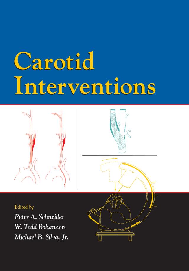 Carotid Interventions by Michael Silva, Peter Schneider, Todd Bohannon