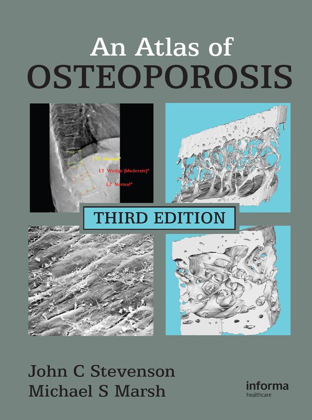 An Atlas of Osteoporosis by John C. Stevenson, Michael S. Marsh