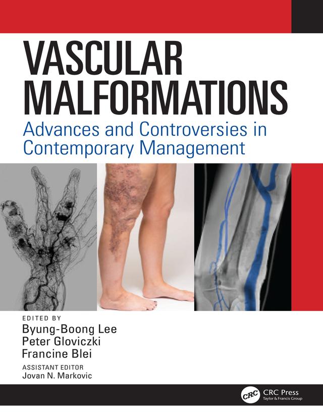 Vascular Malformations by Byung Boong Lee, Francine Blei, Peter Gloviczki