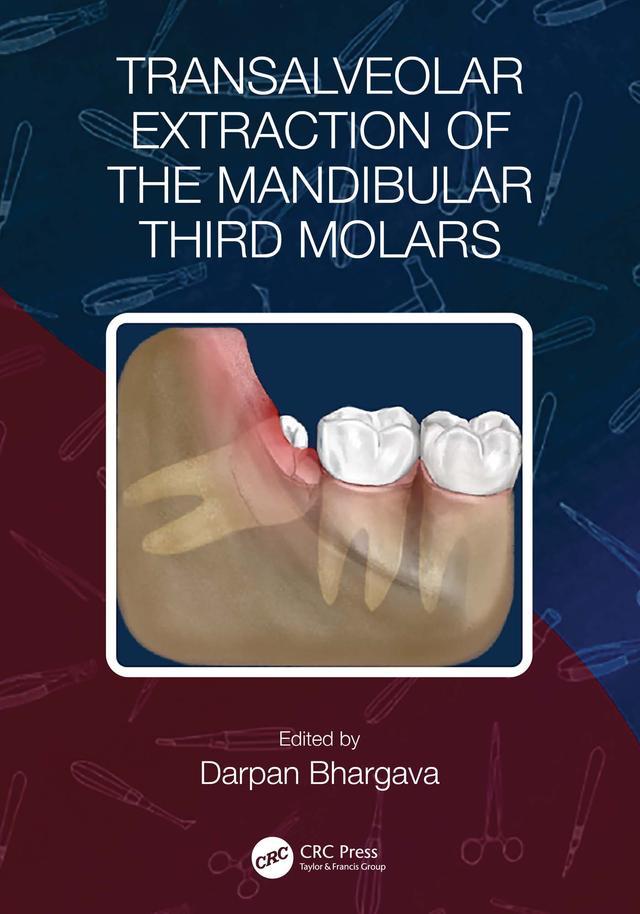 Transalveolar Extraction of the Mandibular Third Molars by Darpan Bhargava