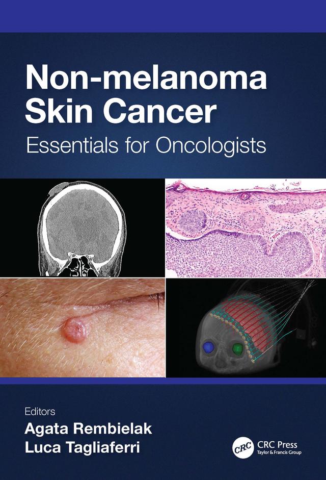 Non-melanoma Skin Cancer by Agata Rembielak, Luca Tagliaferri