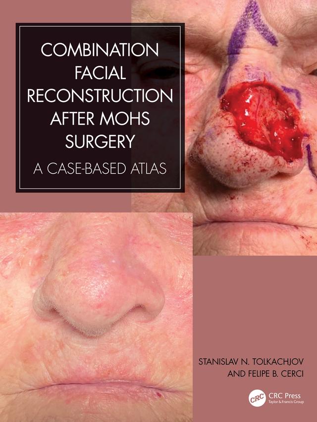 Combination Facial Reconstruction after Mohs Surgery by Felipe B. Cerci, Stanislav N. Tolkachjov