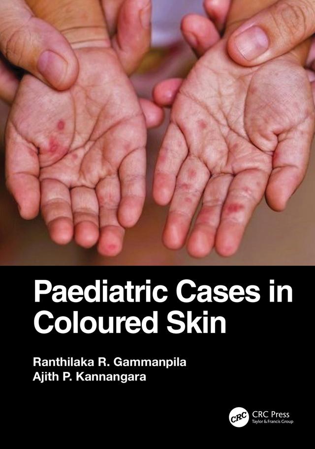 Paediatric Cases in Coloured Skin by Ajith P. Kannangara, Ranthilaka R. Gammanpila