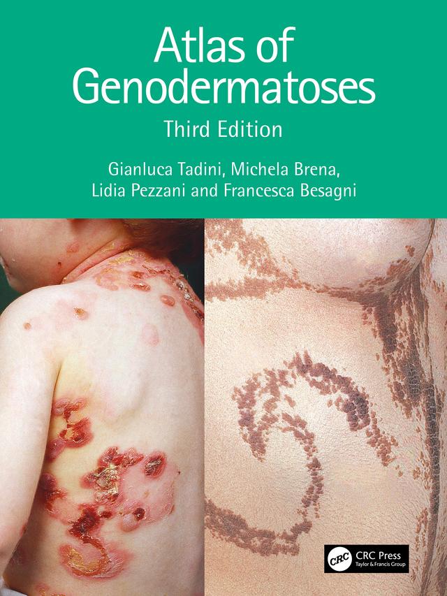 Atlas of Genodermatoses by Francesca Besagni, Gianluca Tadini, Lidia Pezzani, Michela Brena