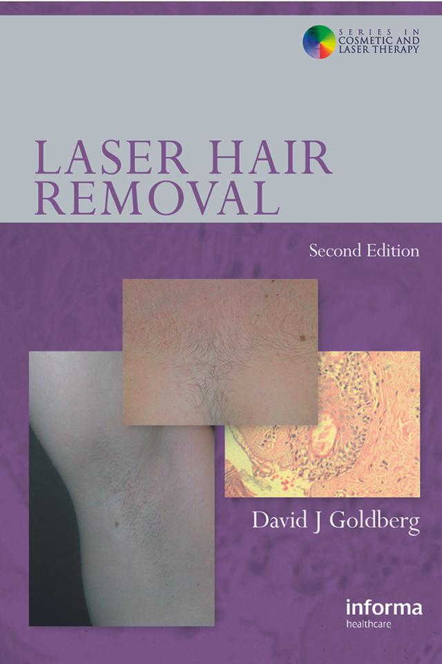 Laser Hair Removal by David J. Goldberg