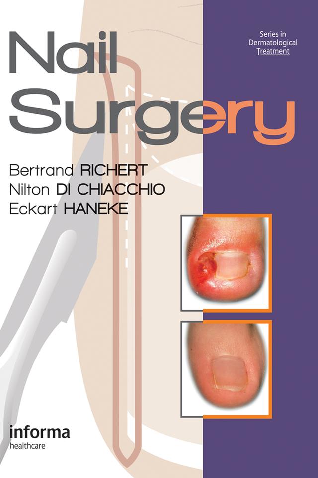 Nail Surgery by Bertrand Richert, Eckart Haneke, Nilton Di Chiacchio