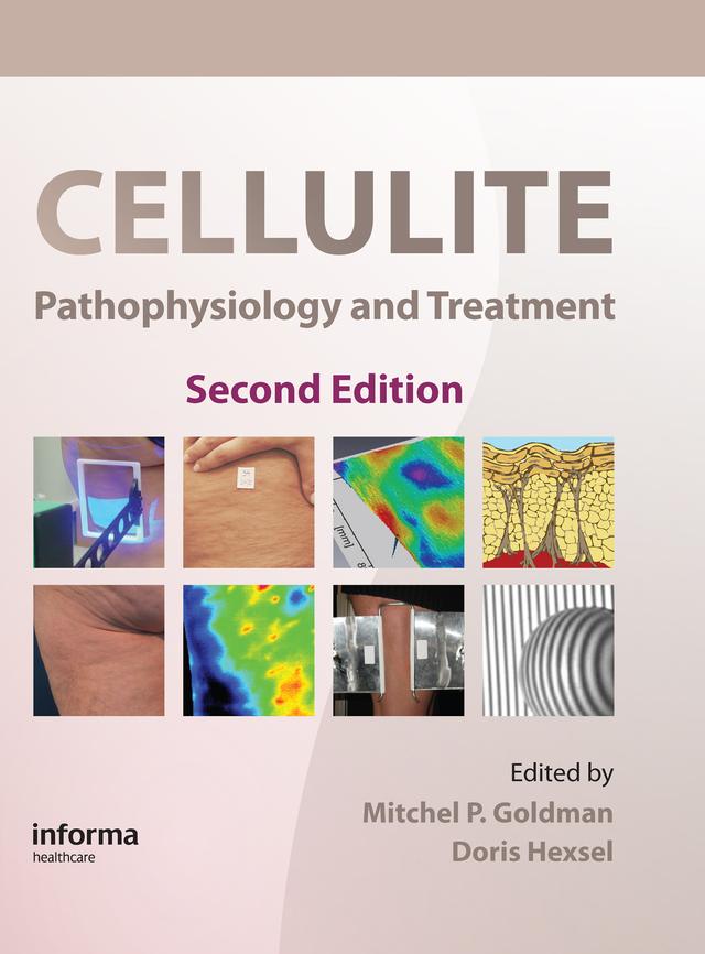 Cellulite by Doris Hexsel, Mitchel P. Goldman
