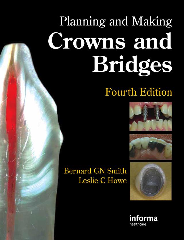 Planning and Making Crowns and Bridges by Bernard G.N. Smith, Leslie C. Howe