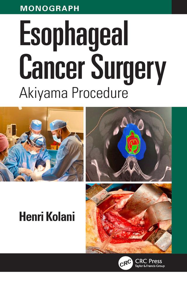 Esophageal Cancer Surgery by Henri Kolani