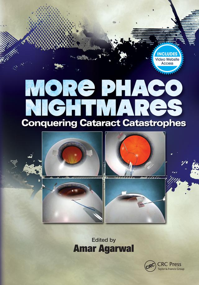 More Phaco Nightmares by Amar Agarwal