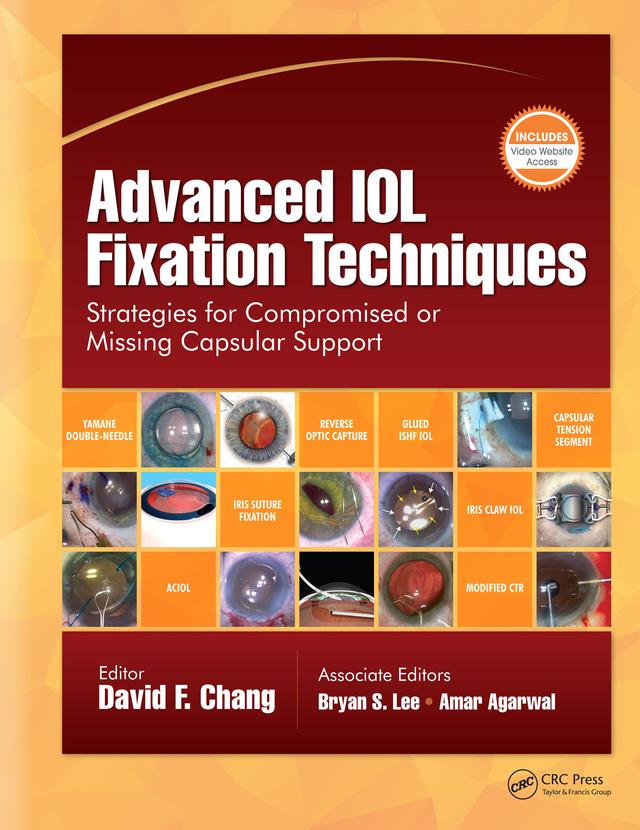 Advanced IOL Fixation Techniques by David F. Chang