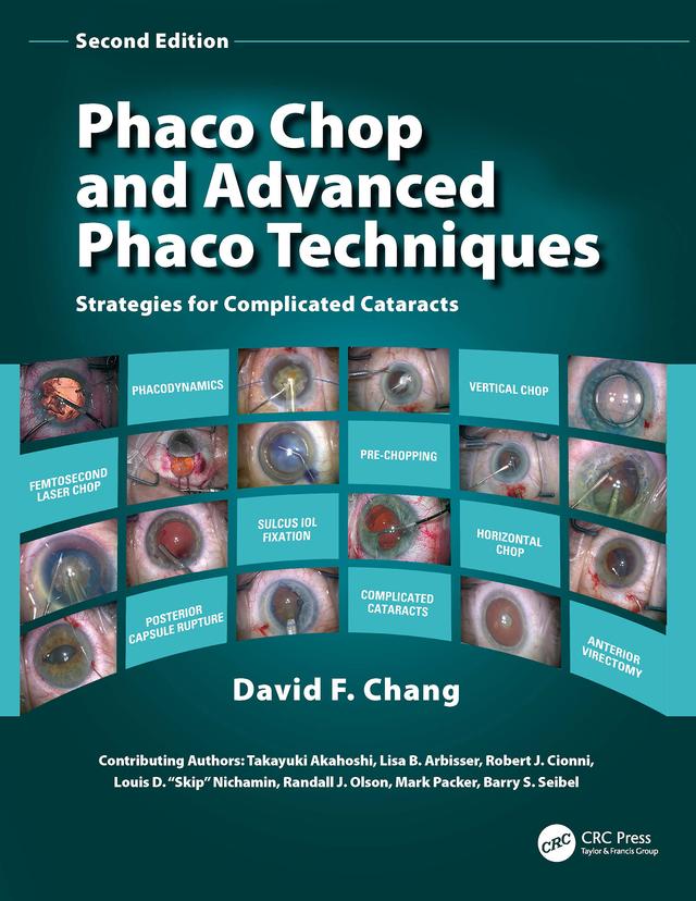 Phaco Chop and Advanced Phaco Techniques by David F. Chang