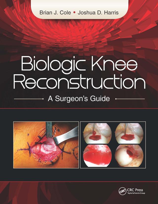 Biologic Knee Reconstruction by Brian Cole, Joshua Harris