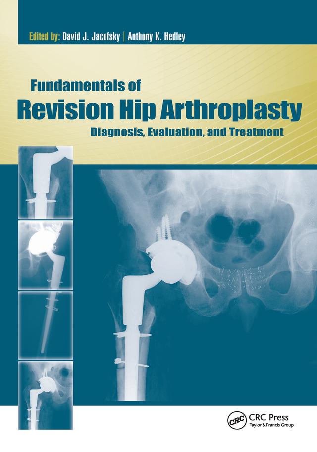 Fundamentals of Revision Hip Arthroplasty by Anthony Hedley, David Jacofsky