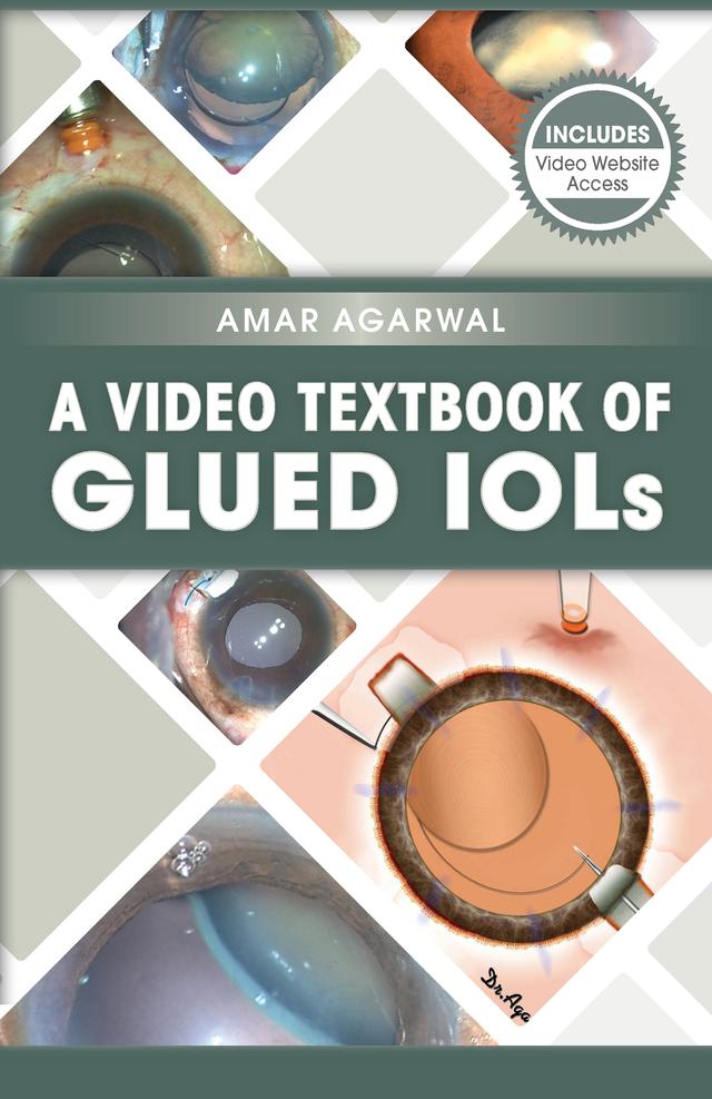 A Video Textbook of Glued IOLs by Amar Agarwal