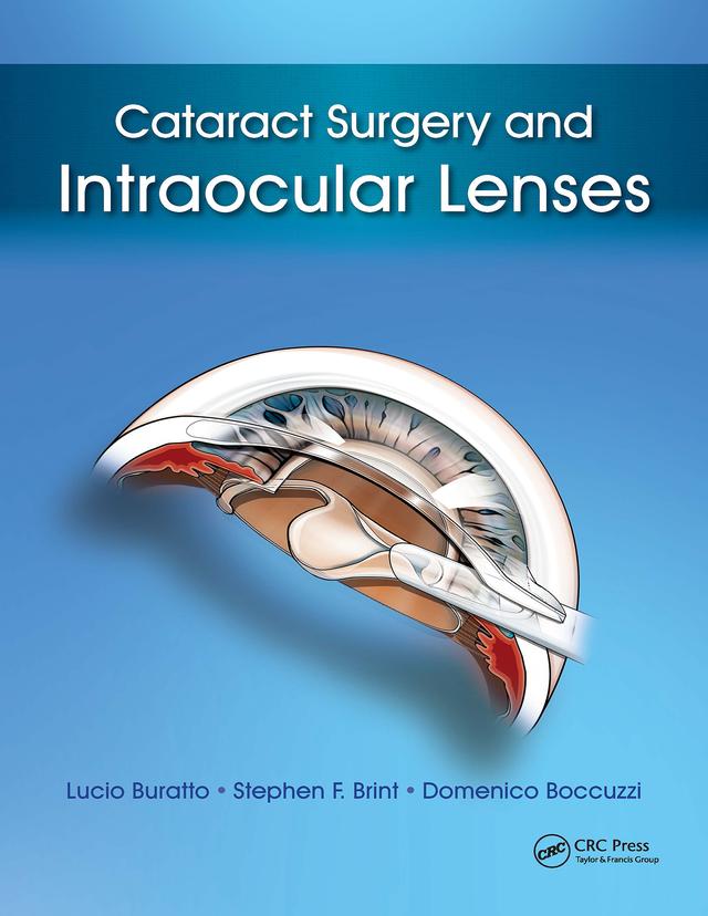 Cataract Surgery and Intraocular Lenses by Domenico Boccuzzi, Lucio Buratto, Stephen Brint