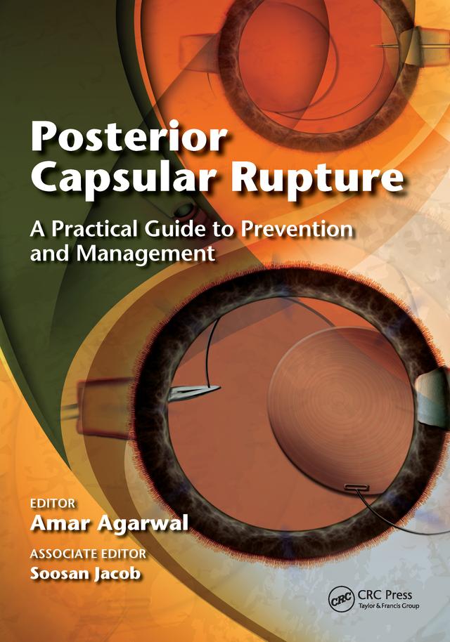 Posterior Capsular Rupture by Amar Agarwal