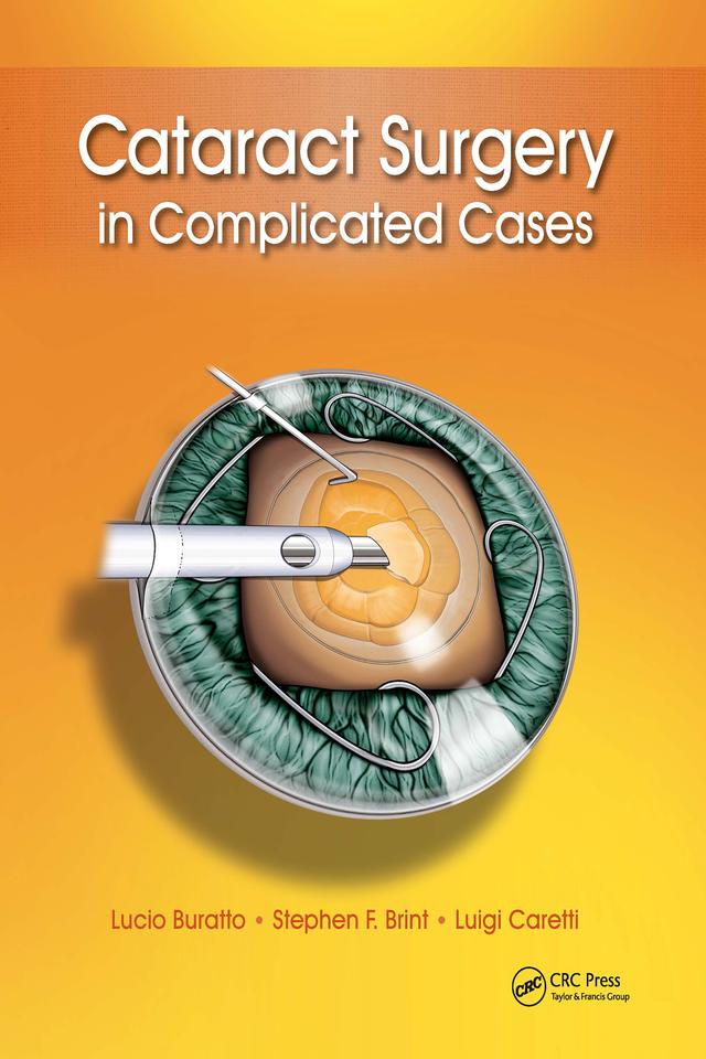 Cataract Surgery in Complicated Cases by Lucio Buratto, Luigi Caretti, Stephen Brint
