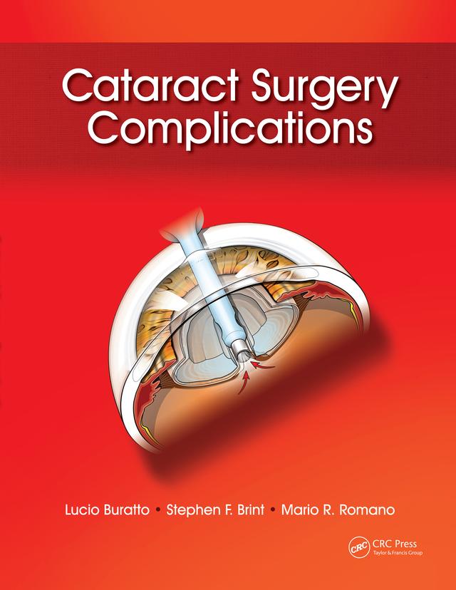 Cataract Surgery Complications by Lucio Buratto, Mario Romano, Stephen Brint
