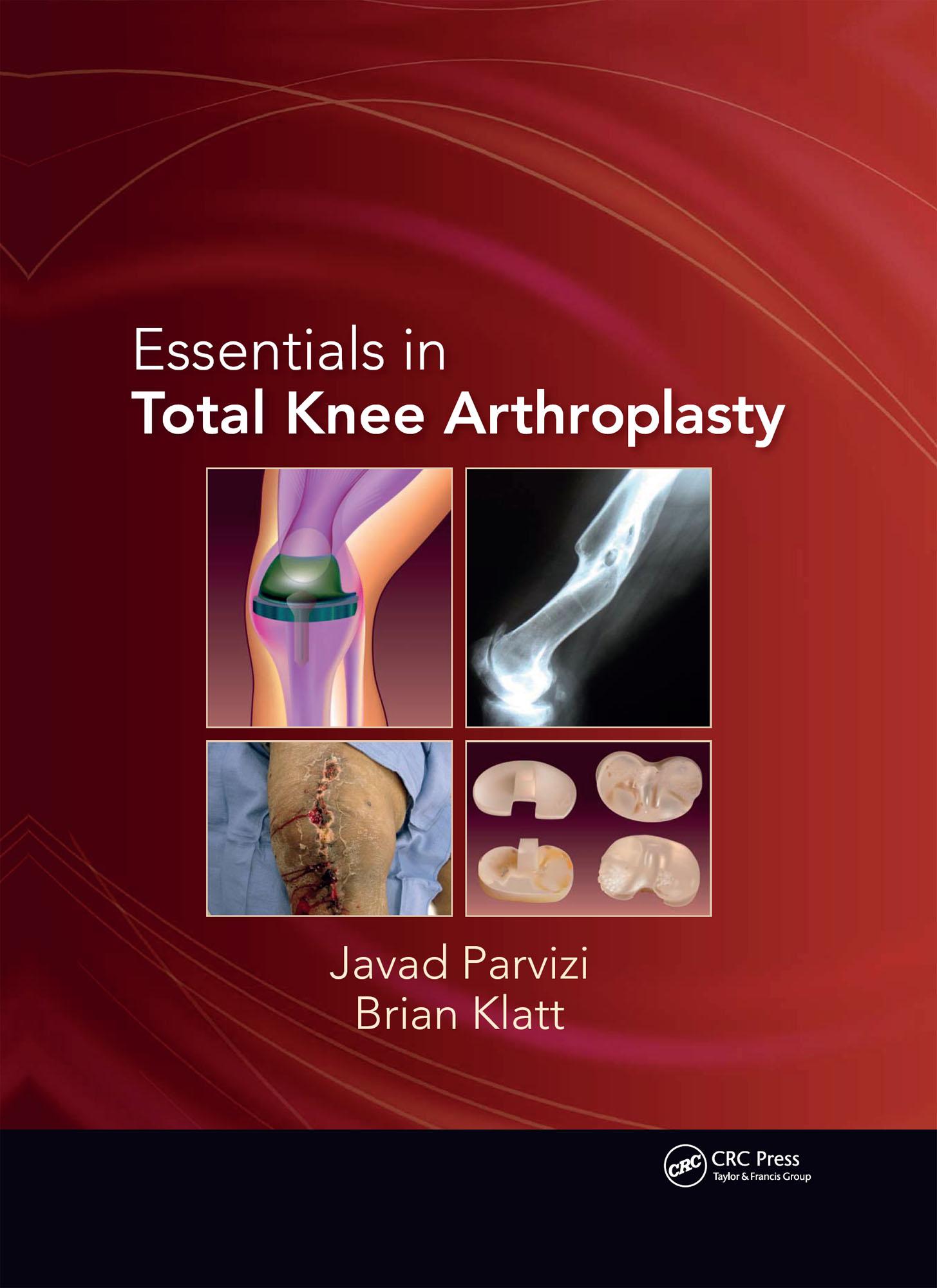 Essentials in Total Knee Arthroplasty