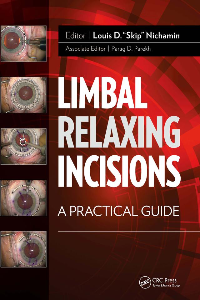 Limbal Relaxing Incisions by Louis Nichamin