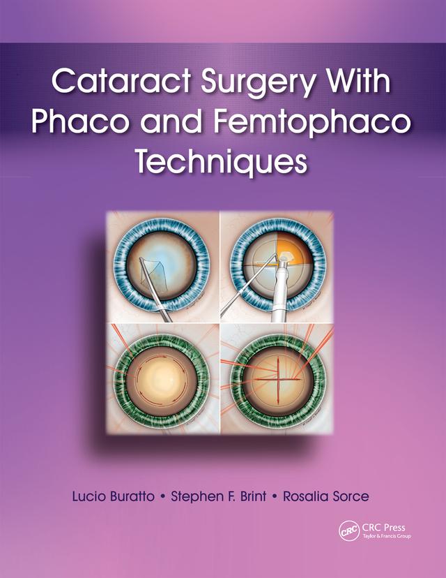 Cataract Surgery With Phaco and Femtophaco Techniques by Lucio Buratto, Rosalia Sorce, Stephen Brint