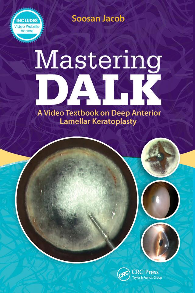 Mastering DALK by Soosan Jacob
