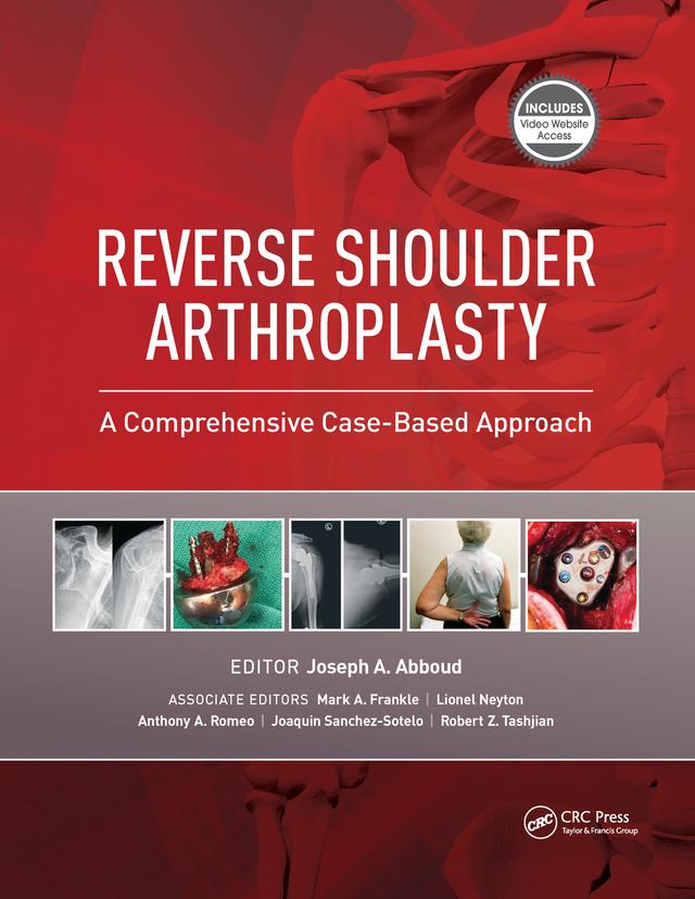 Reverse Shoulder Arthroplasty by Joseph Abboud