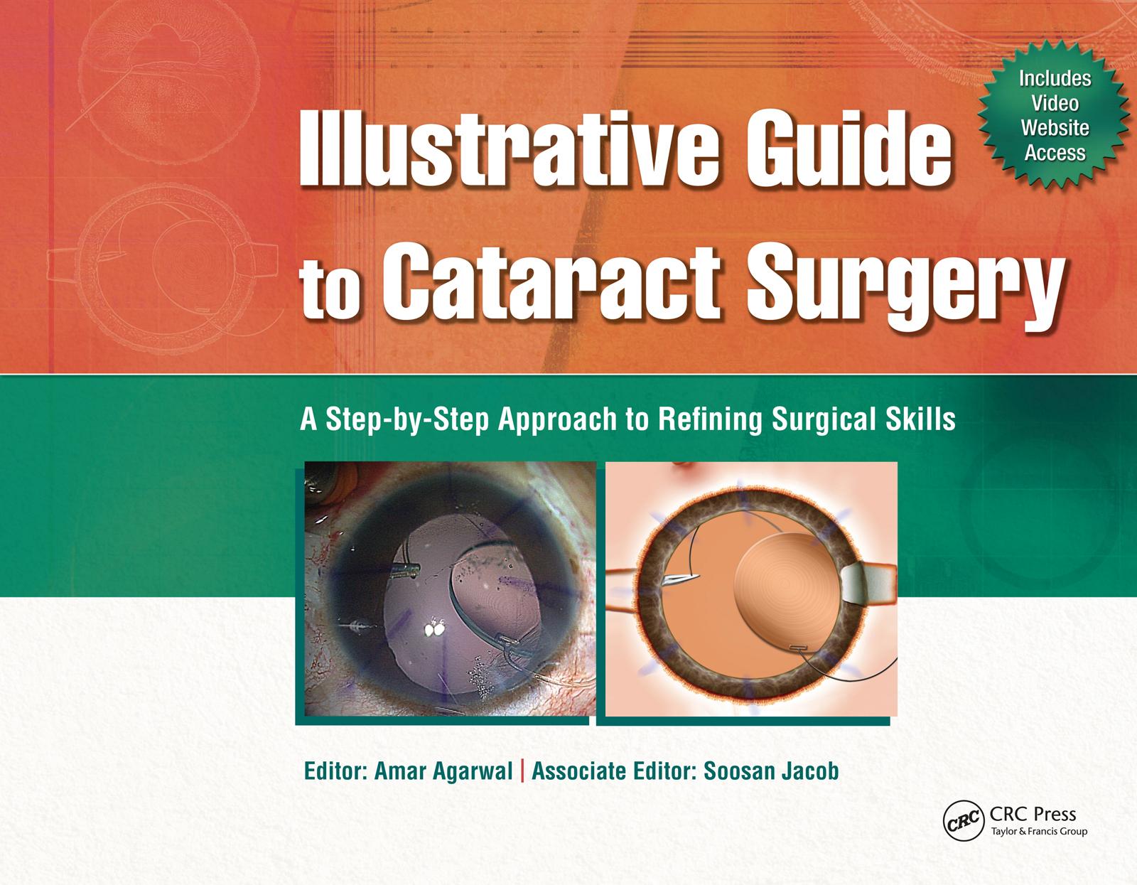 Illustrative Guide to Cataract Surgery