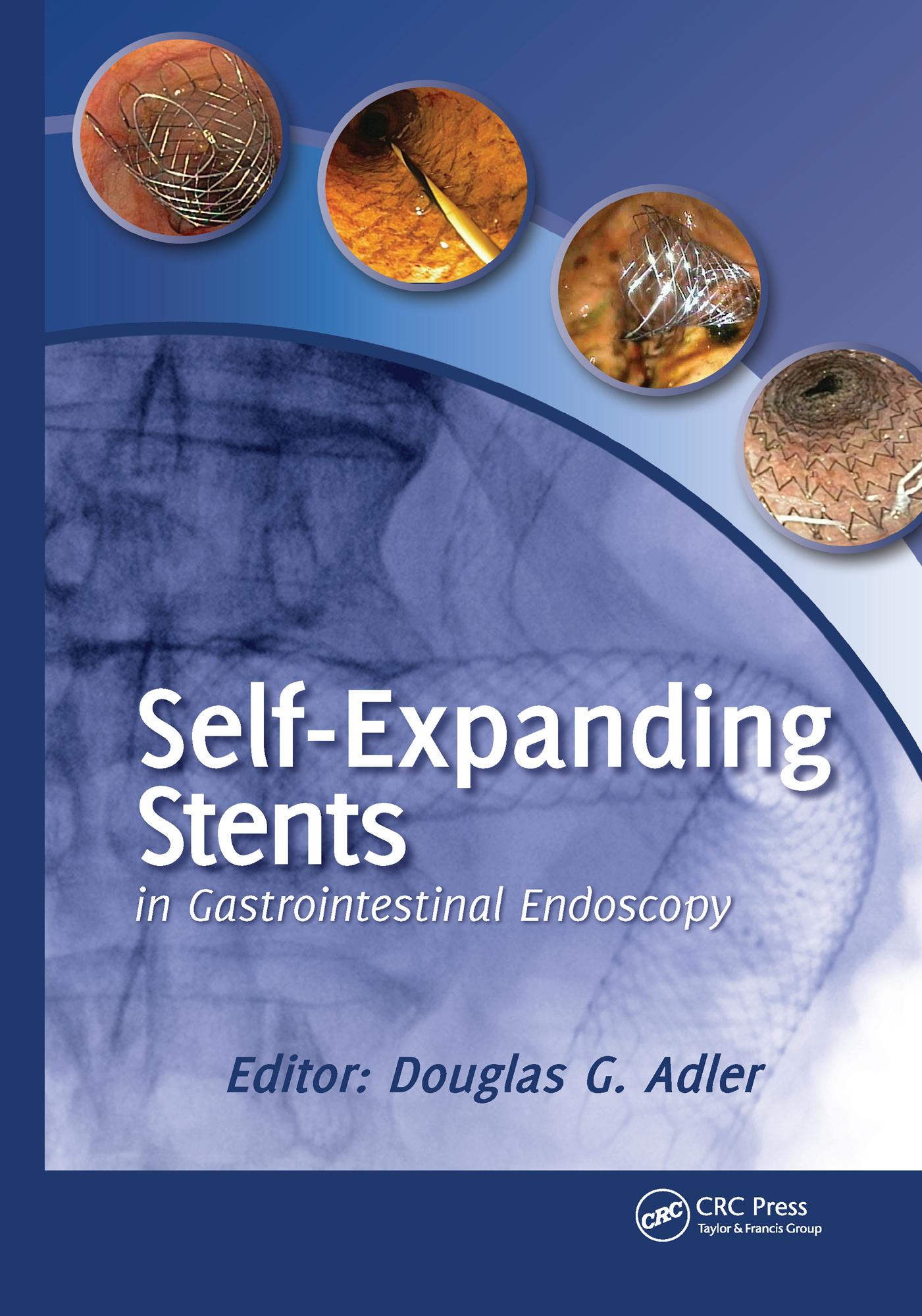 Self-Expanding Stents in Gastrointestinal Endoscopy