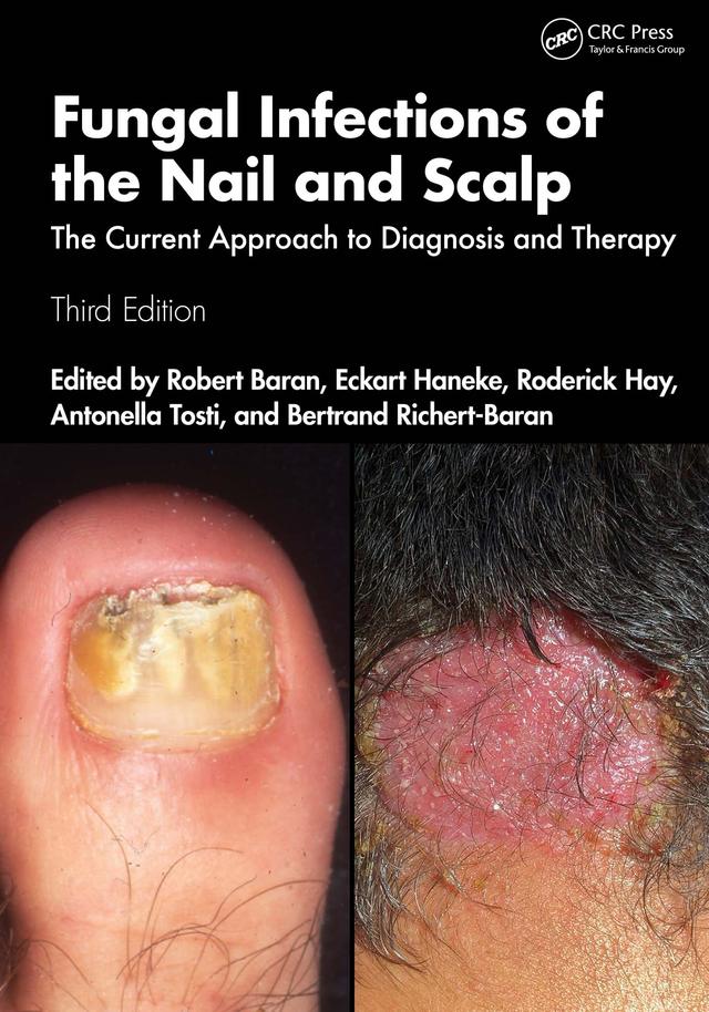 Fungal Infections of the Nail and Scalp by Antonella Tosti, Bertrand Richert-Baran, Eckart Haneke, Robert Baran, Roderick Hay