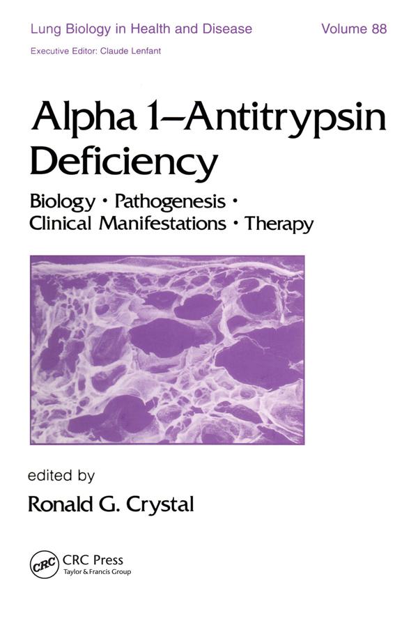 Alpha 1 - Antitrypsin Deficiency by Ronald G. Crystal