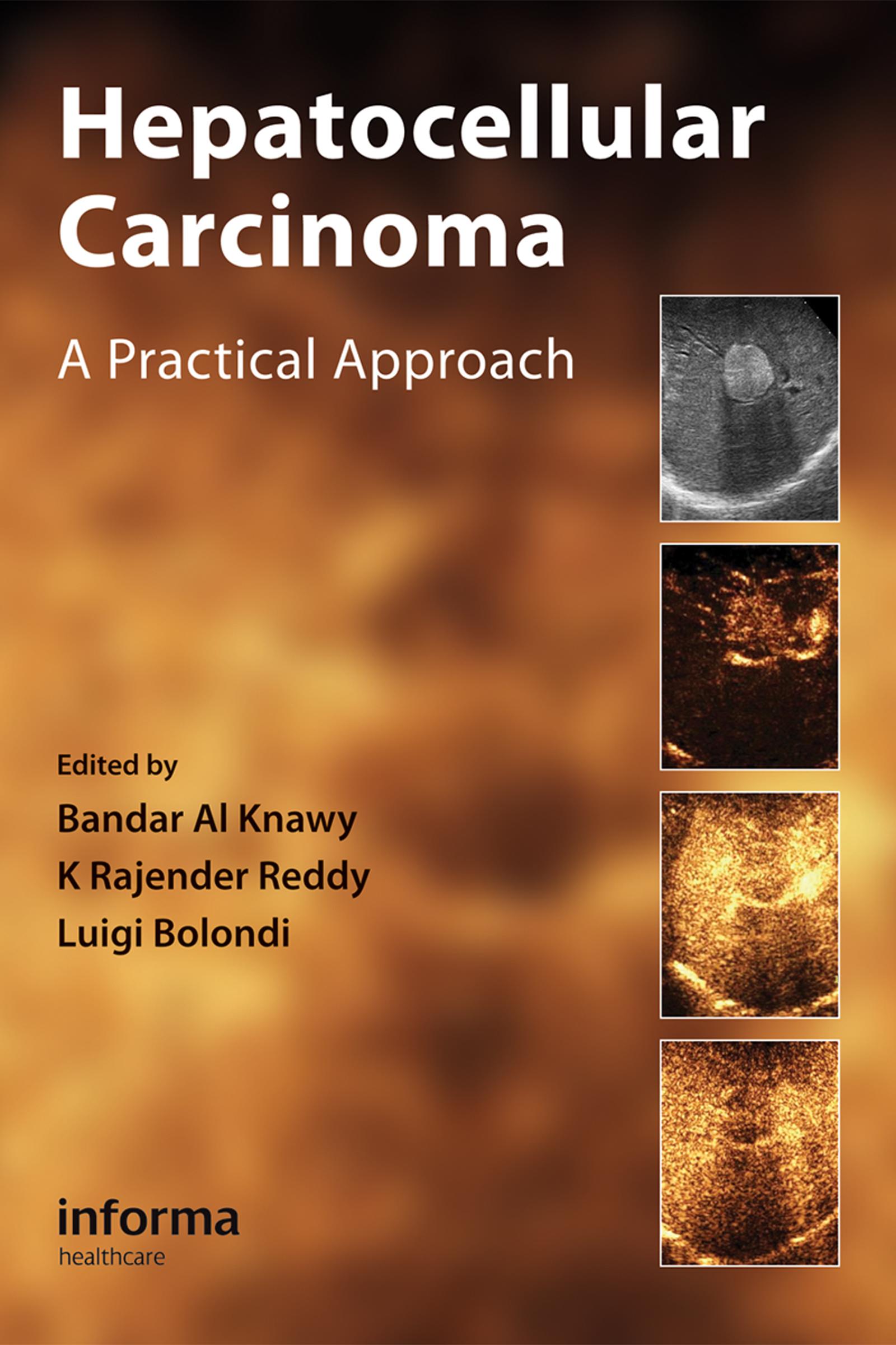 Hepatocellular Carcinoma